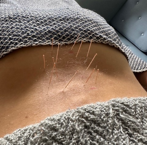 3 x Akupunkturbehandling